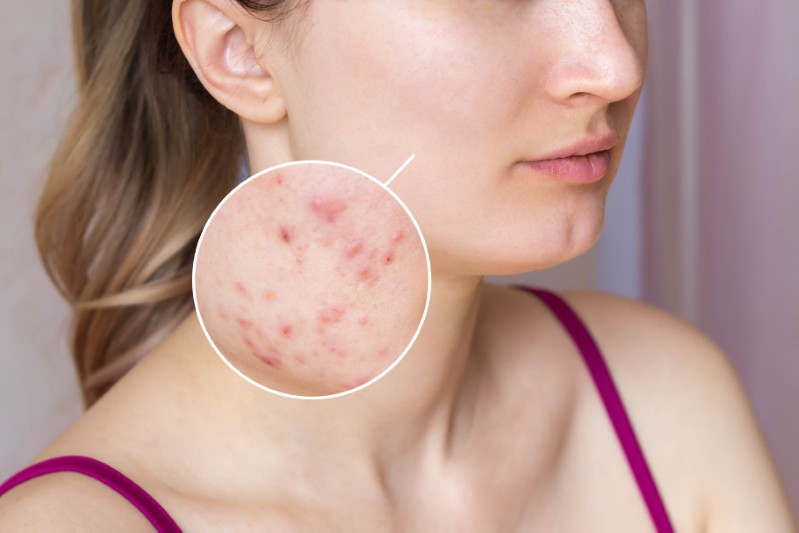 Trądzik grzybiczy (Fungal Acne): To wcale nie jest trądzik. Jak go rozpoznać i leczyć?