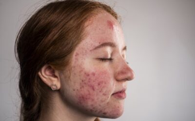 Trądzik piorunujący (Acne Fulminans): Gdy trądzik atakuje cały organizm. Stan nagły w dermatologii