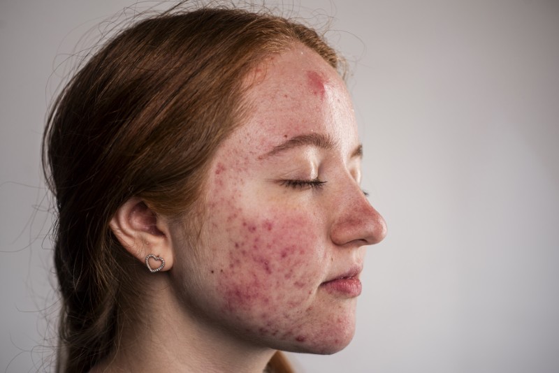 Trądzik piorunujący (Acne Fulminans): Gdy trądzik atakuje cały organizm. Stan nagły w dermatologii