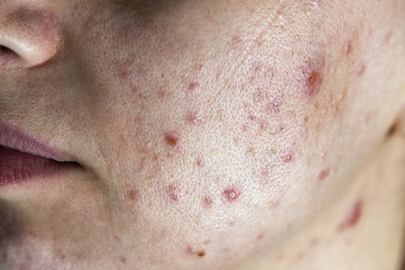 Trądzik pospolity (Acne Vulgaris)