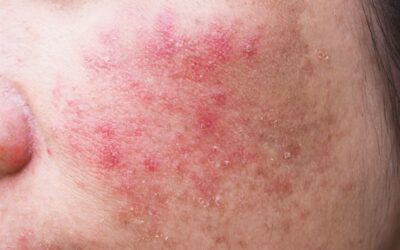 Trądzik różowaty (Rosacea): Kompendium wiedzy. Objawy, przyczyny i skuteczne leczenie “czerwonej twarzy”