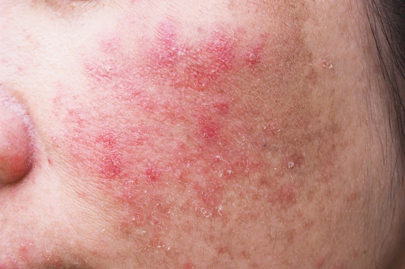 Trądzik różowaty (Rosacea): Kompendium wiedzy. Objawy, przyczyny i skuteczne leczenie “czerwonej twarzy”